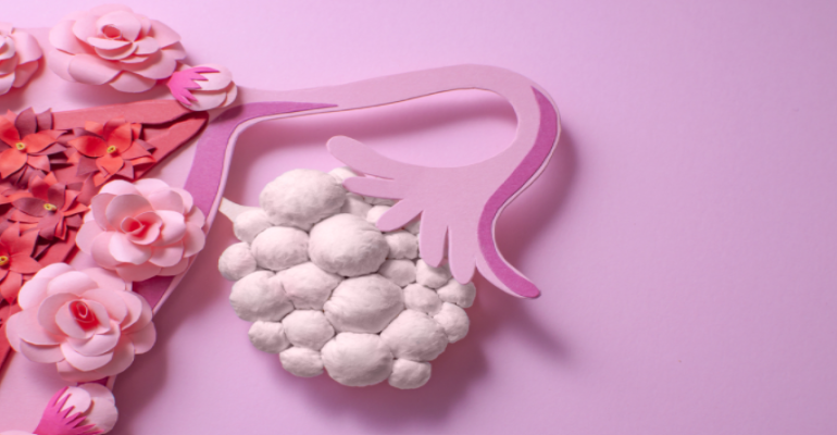 Von A bis Z: Eierstockzyste